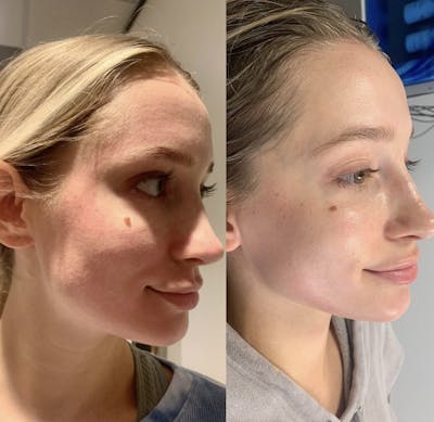 Microneedling with SkinPen Before & After Gallery - Patient 383430 - Image 1