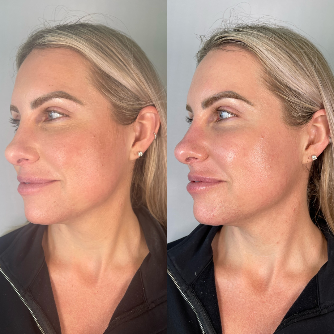 Hydrafacial Before & After Gallery - Patient 237284 - Image 2