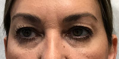 Blepharoplasty (Eyelid Surgery) Before & After Gallery - Patient 331135 - Image 1