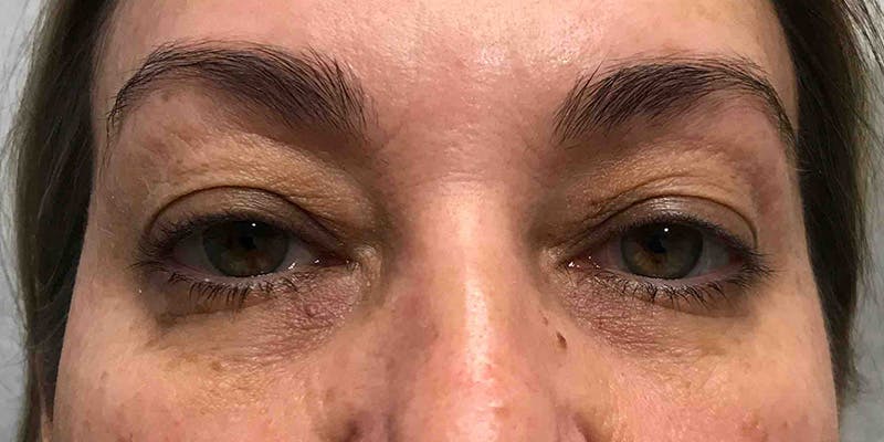 Blepharoplasty (Eyelid Surgery) Before & After Gallery - Patient 331135 - Image 2
