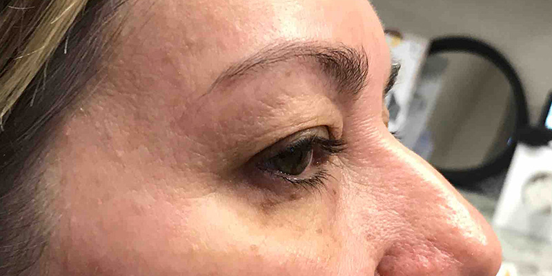 Blepharoplasty (Eyelid Surgery) Before & After Gallery - Patient 331135 - Image 4
