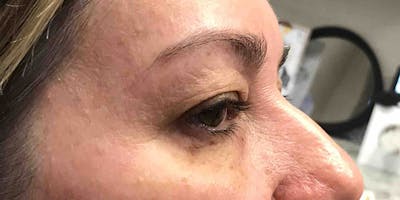 Blepharoplasty (Eyelid Surgery) Before & After Gallery - Patient 331135 - Image 4