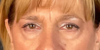 Blepharoplasty (Eyelid Surgery) Before & After Gallery - Patient 214741 - Image 1