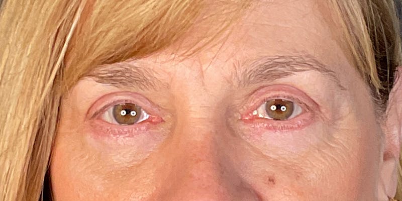 Blepharoplasty (Eyelid Surgery) Before & After Gallery - Patient 214741 - Image 2