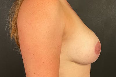 Breast Augmentation Before & After Gallery - Patient 239966 - Image 6