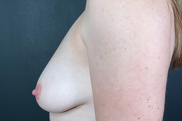 Breast Lift with Implants Before & After Gallery - Patient 218359 - Image 7