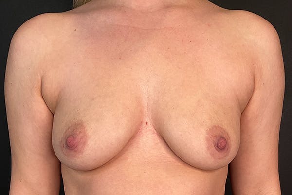 Breast Augmentation Before & After Gallery - Patient 274095 - Image 1