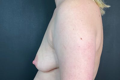 Breast Augmentation Before & After Gallery - Patient 274095 - Image 10