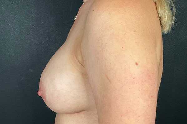 Breast Augmentation Before & After Gallery - Patient 274095 - Image 9
