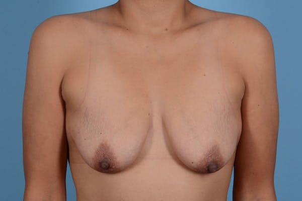 Breast Augmentation with Lift Before & After Gallery - Patient 371877 - Image 1