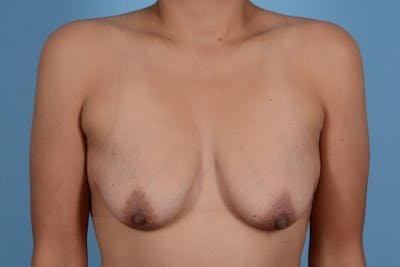 Breast Augmentation with Lift Before & After Gallery - Patient 371877 - Image 1