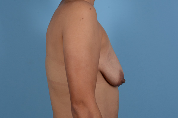 Breast Augmentation with Lift Before & After Gallery - Patient 371877 - Image 5