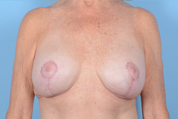 Breast Lift with Implants Before & After Gallery - Patient 327804 - Image 2