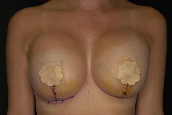 Breast Augmentation with Lift Before & After Gallery - Patient 104391 - Image 2