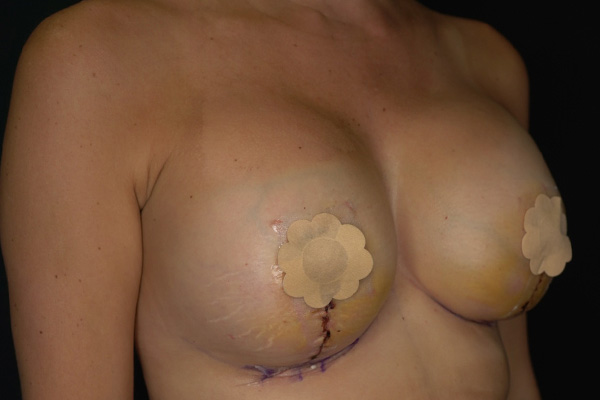 Breast Augmentation with Lift Before & After Gallery - Patient 104391 - Image 4