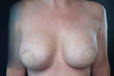 Breast Augmentation Before & After Gallery - Patient 171625 - Image 2