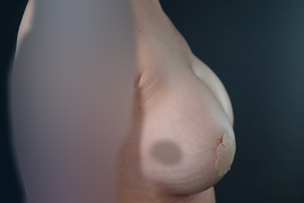 Breast Augmentation Before & After Gallery - Patient 171625 - Image 6