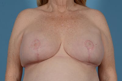 Breast Lift with Implants Before & After Gallery - Patient 218124 - Image 2