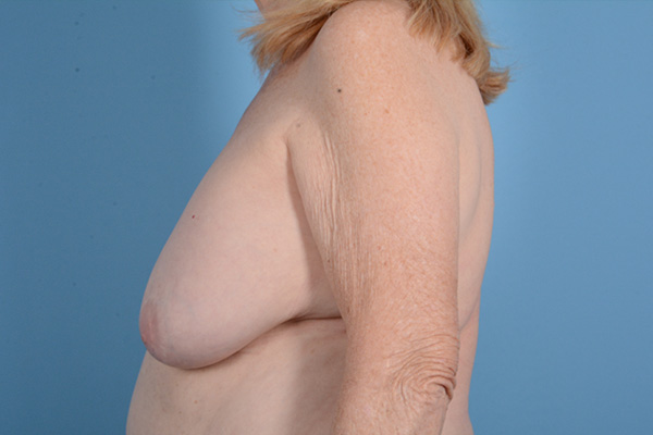 Breast Augmentation with Lift Before & After Gallery - Patient 218124 - Image 9