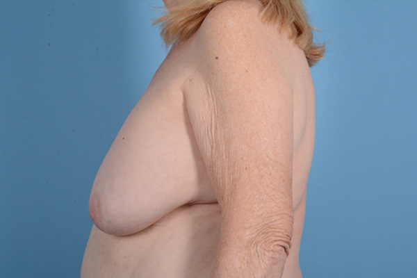 Breast Lift with Implants Before & After Gallery - Patient 218124 - Image 9