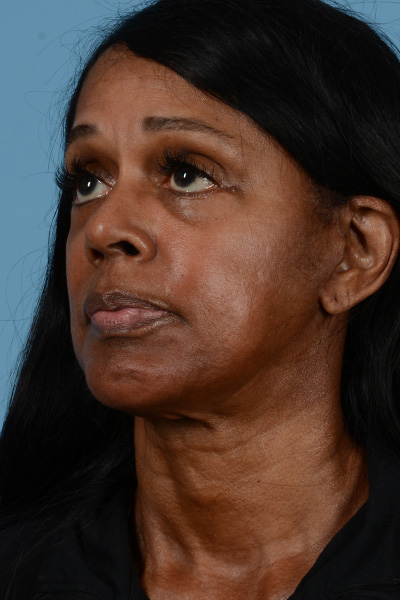 Facelift Before & After Gallery - Patient 171743 - Image 6