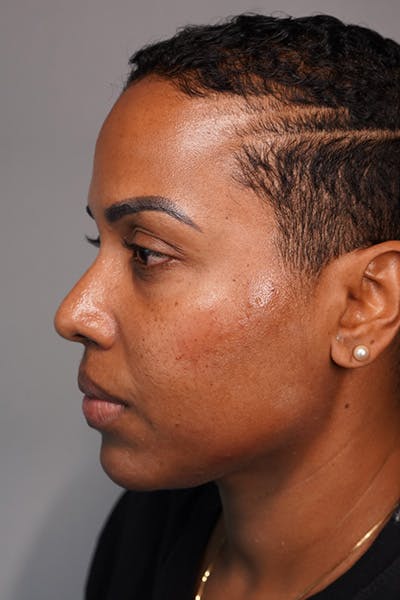 Facial Rejuvenation (Facial Balancing)  Before & After Gallery - Patient 199430 - Image 6