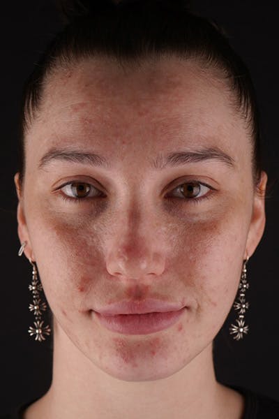 Laser Skin Resufacing Before & After Gallery - Patient 180193000 - Image 1