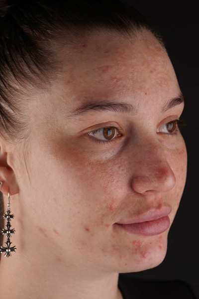 Laser Skin Resufacing Before & After Gallery - Patient 180193000 - Image 3