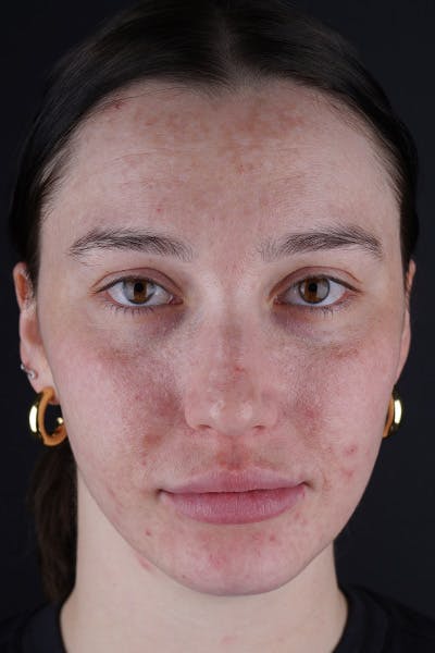Laser Skin Resufacing Before & After Gallery - Patient 180193000 - Image 2
