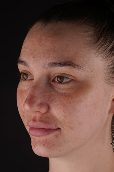 Laser Skin Resufacing Before & After Gallery - Patient 180193000 - Image 5