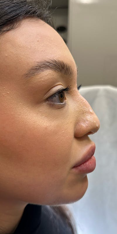 Non-Surgical Rhinoplasty Before & After Gallery - Patient 397322 - Image 1