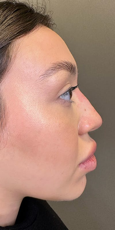 Non-Surgical Rhinoplasty Before & After Gallery - Patient 397322 - Image 2