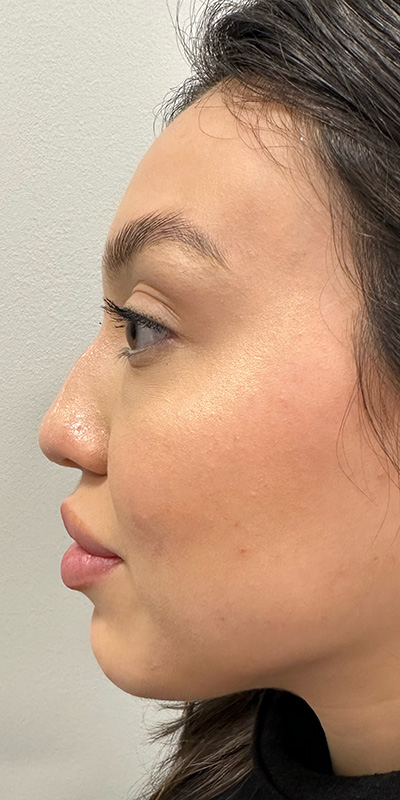Non-Surgical Rhinoplasty Before & After Gallery - Patient 397322 - Image 3