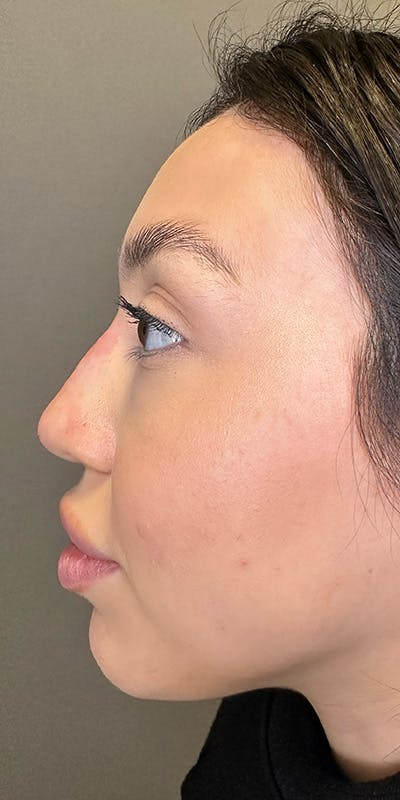 Non-Surgical Rhinoplasty Before & After Gallery - Patient 397322 - Image 4