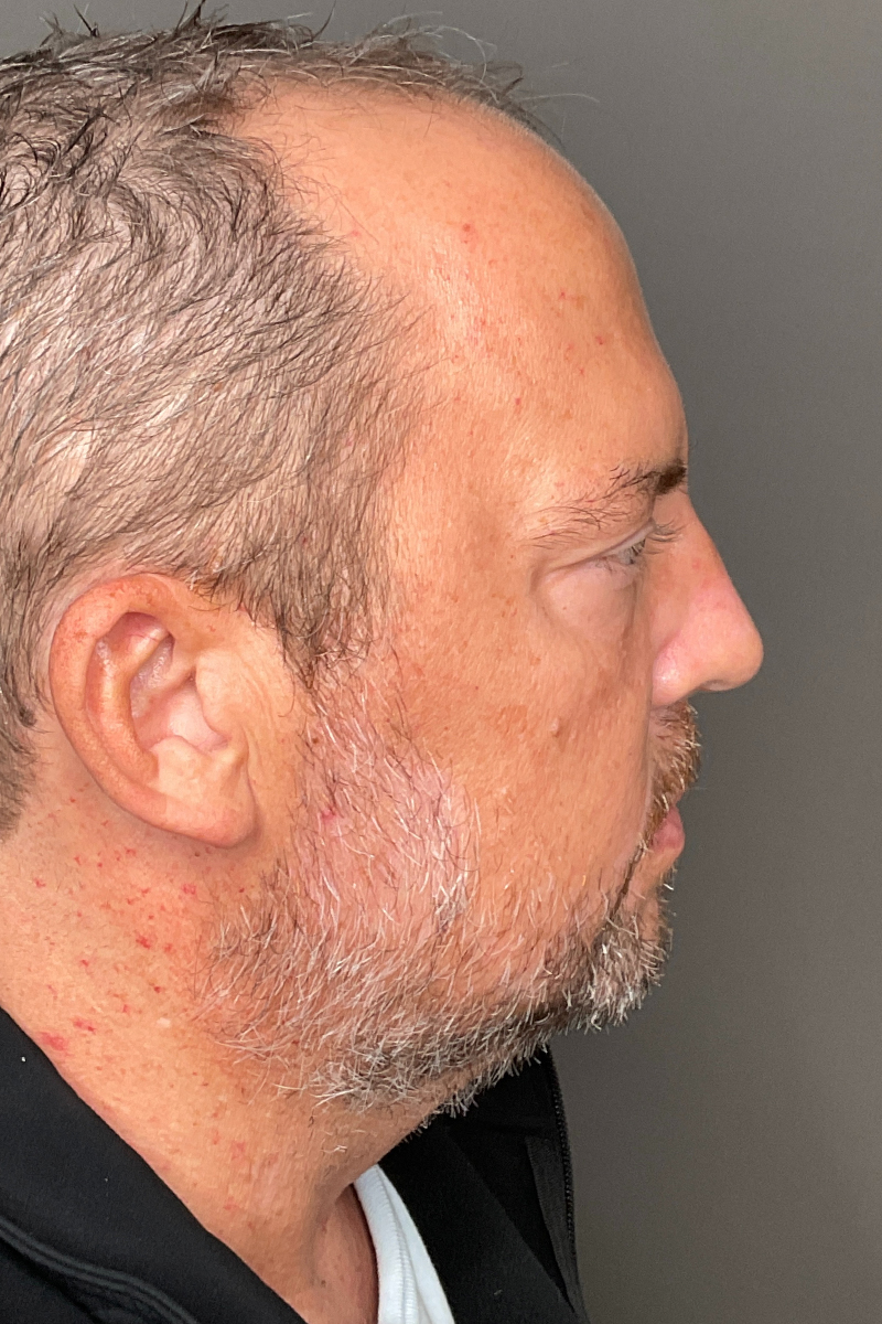RHA Fillers Before & After Gallery - Patient 380508 - Image 10