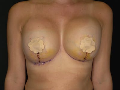 Breast Augmentation with Lift Before & After Gallery - Patient 101058 - Image 2