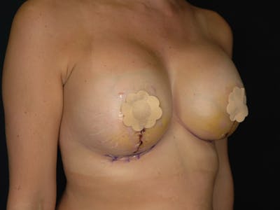 Breast Augmentation Before & After Gallery - Patient 212573 - Image 6