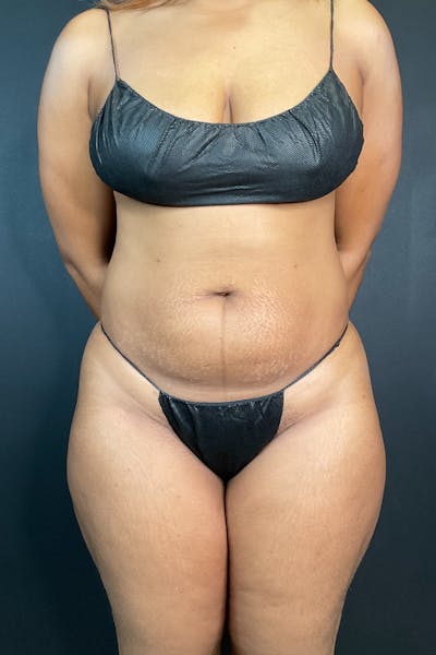 Liposuction Before & After Gallery - Patient 453215 - Image 1