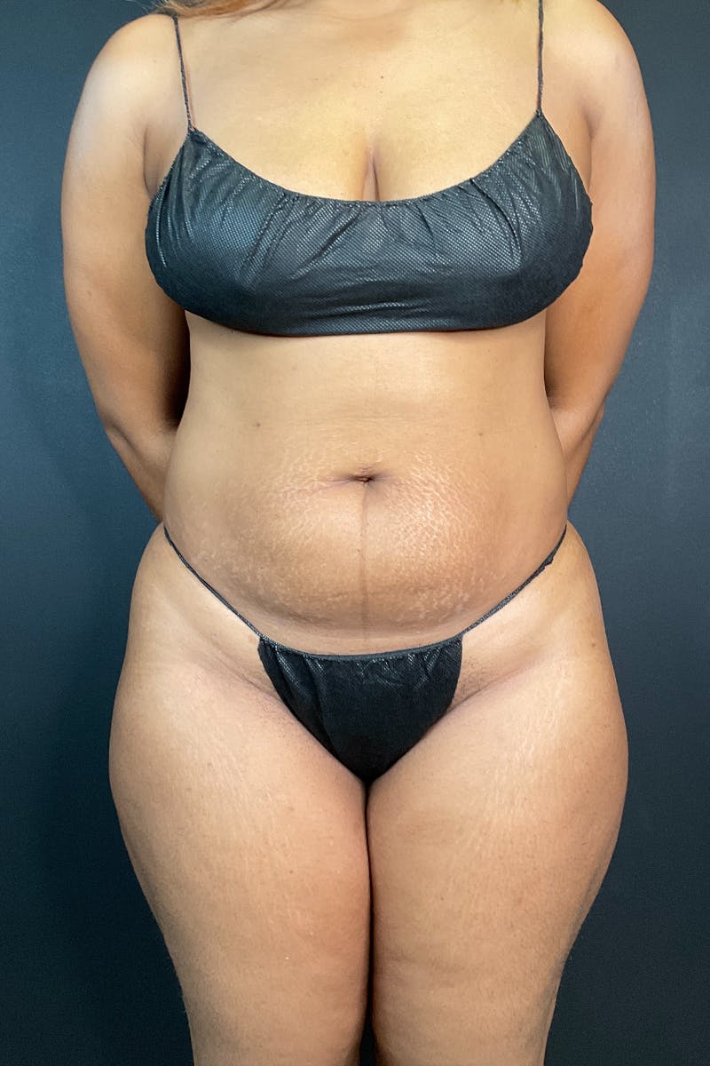 Tummy Tuck (Abdominoplasty)  Before & After Gallery - Patient 162282 - Image 1
