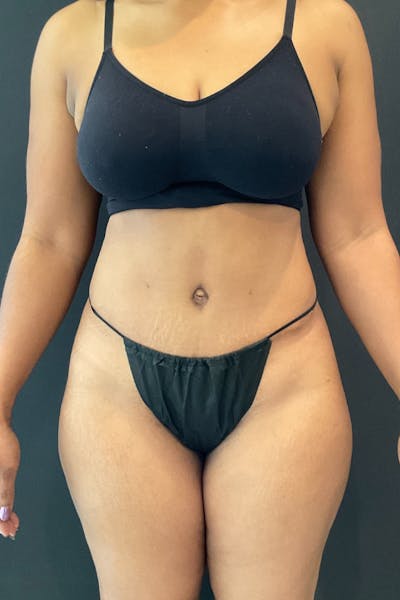 Liposuction Before & After Gallery - Patient 453215 - Image 2