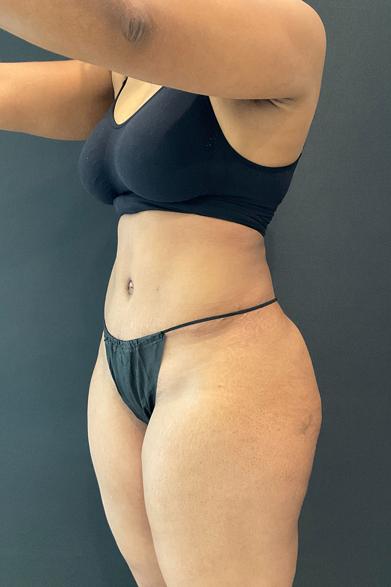 Liposuction Before & After Gallery - Patient 453215 - Image 4