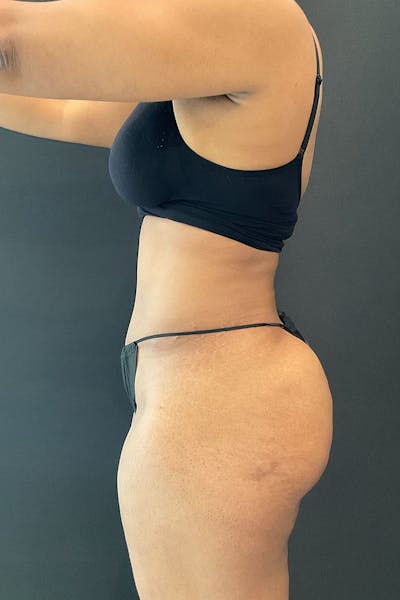 Tummy Tuck (Abdominoplasty)  Before & After Gallery - Patient 162282 - Image 6