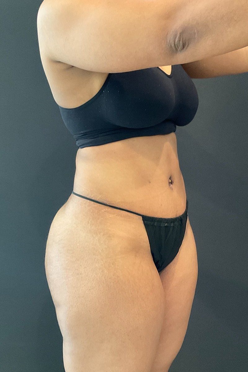 Tummy Tuck (Abdominoplasty)  Before & After Gallery - Patient 162282 - Image 10