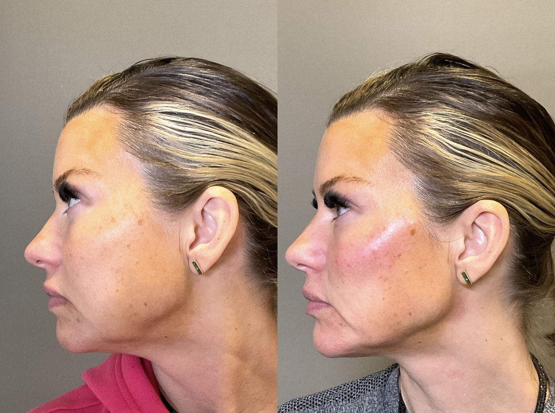 Chin Before & After Gallery - Patient 137596 - Image 1
