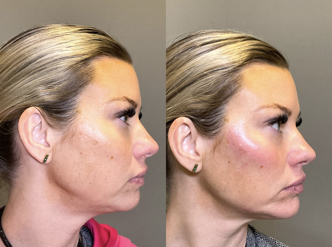Sculptra Before & After Gallery - Patient 166434 - Image 2