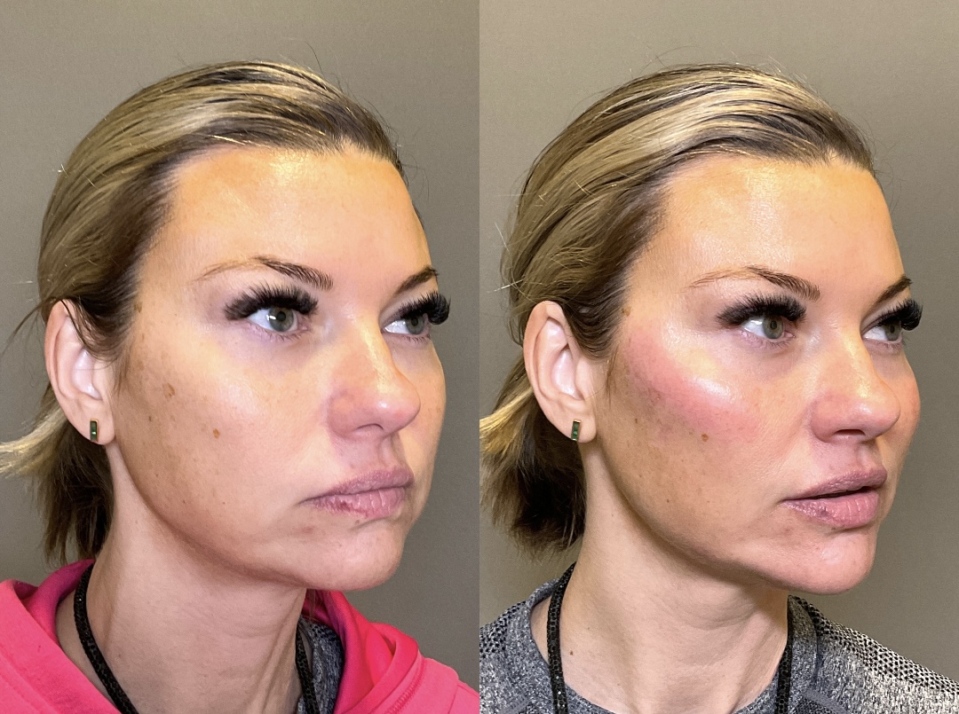Chin Before & After Gallery - Patient 137596 - Image 3