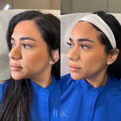 RHA Fillers Before & After Gallery - Patient 371277 - Image 1
