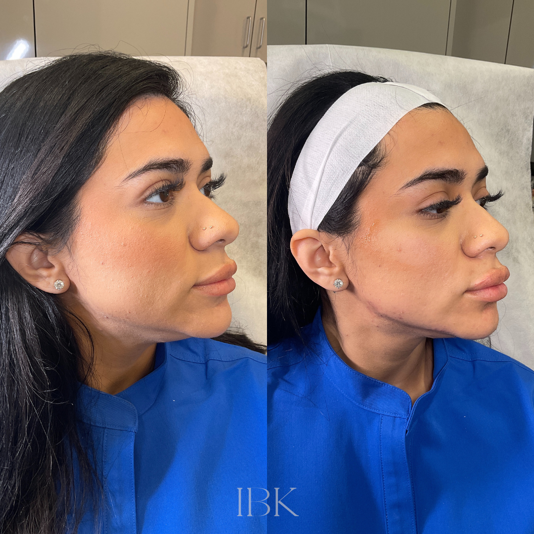 RHA Fillers Before & After Gallery - Patient 371277 - Image 2