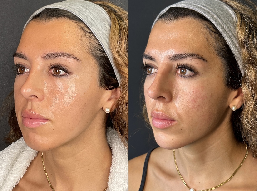 Facial Rejuvenation (Facial Balancing)  Before & After Gallery - Patient 335009 - Image 1