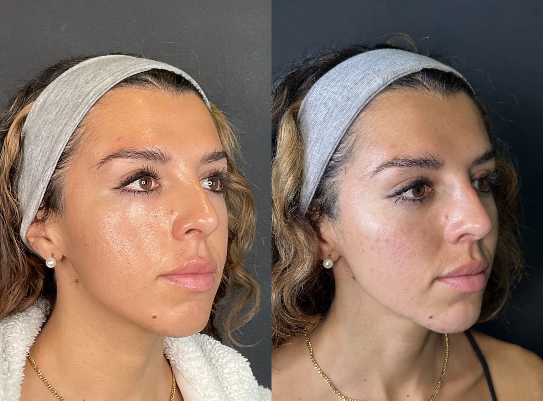 Facial Rejuvenation (Facial Balancing)  Before & After Gallery - Patient 335009 - Image 2